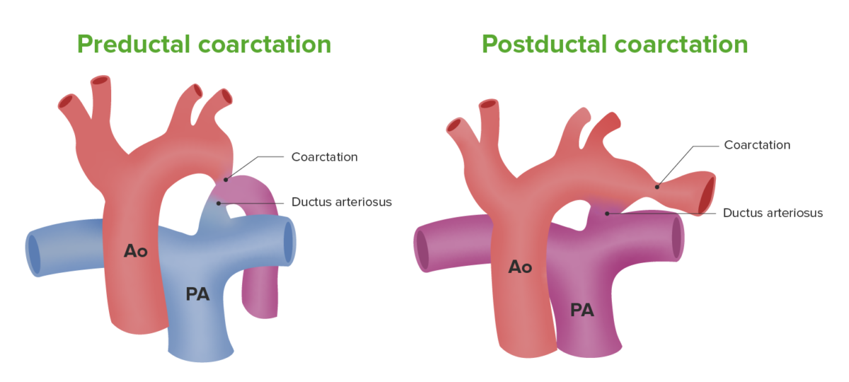Ilustración coartación de la aorta